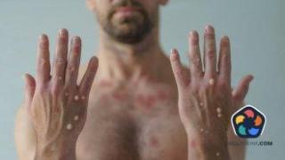 Първи случай на маймунска шарка за годината у нас