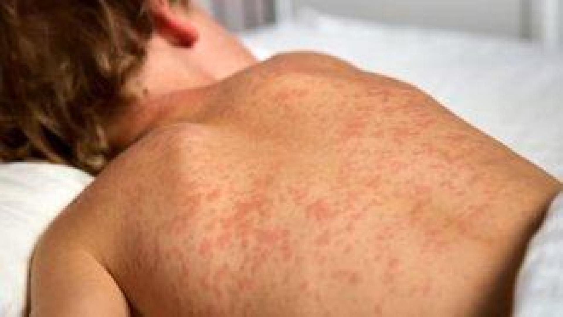 Здравните власти са регистрирали случай на морбили при дете, идващо от Англия