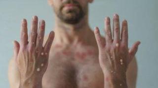 В Северна Македония за първи път са потвърдени случаи на маймунска шарка