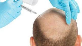 Бум на присаждането на коса в Европа. Промоции с големи отстъпки обаче често крият спорно качество